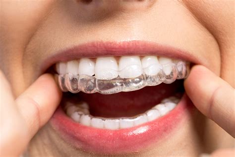 How Long Does It Take for Invisalign to Ship? And Why Does Time Sometimes Feel Like a Rubber Band?